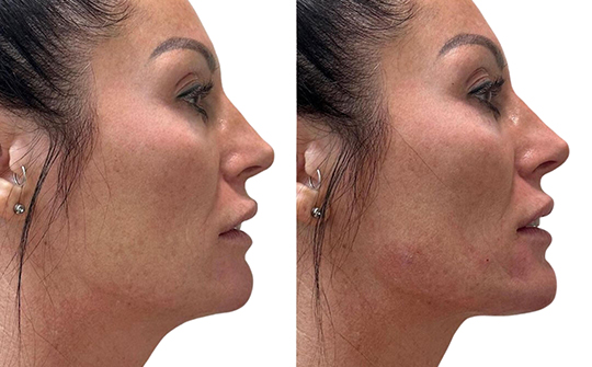 Patient Results - Skinrejuvenate