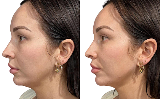 Patient Results - Skinrejuvenate