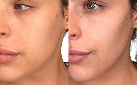 Patient Results - Skinrejuvenate
