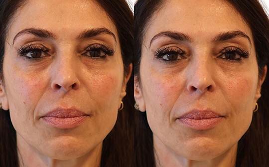 Patient Results - Skinrejuvenate