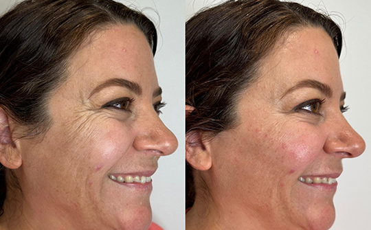 Patient Results - Skinrejuvenate