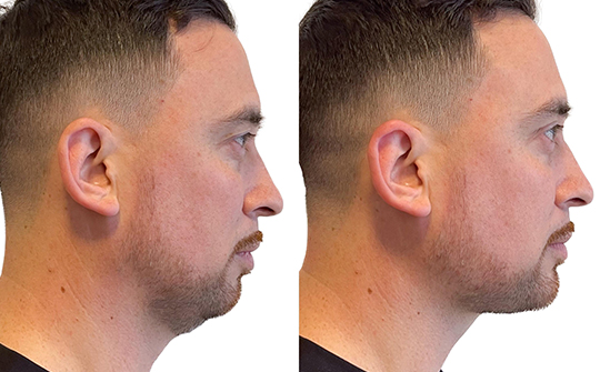 Patient Results - Skinrejuvenate