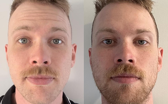 Patient Results - Skinrejuvenate