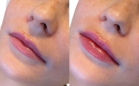 Patient Results - Skinrejuvenate