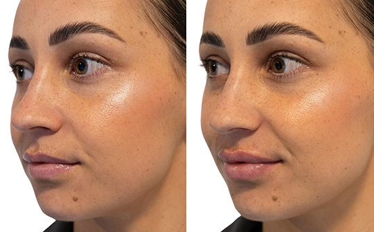 Patient Results - Skinrejuvenate
