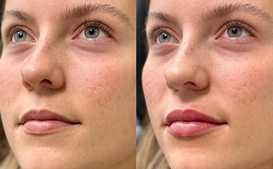 Patient Results - Skinrejuvenate