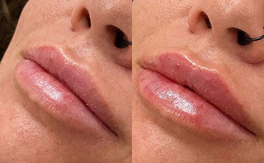 Patient Results - Skinrejuvenate