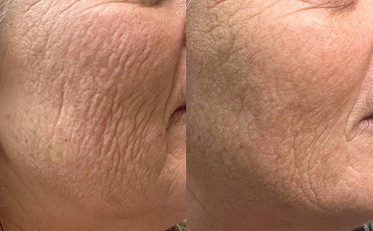 Patient Results - Skinrejuvenate