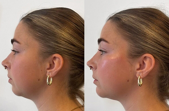 Patient Results - Skinrejuvenate